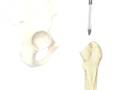 videos de Malpractice Medical Hip Replacement Surgery 3