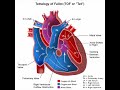 Tetralogy of fallot (TOF) Tetralogy of fallot (TOF)