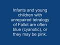 Tetralogy of fallot (TOF)