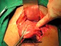 TAH cervical fibroid.mp4