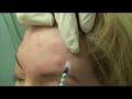 Botox maintenance treatments