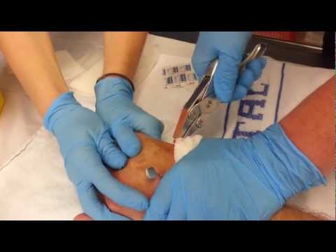 how to remove k wires