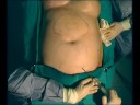 Liposuzione (liposcultura) Liposuction (Liposculpture) Liposuzione (liposcultura) Liposuction (Liposculpture)