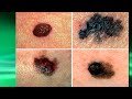 Early Detection of Melanoma