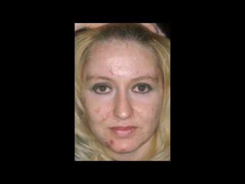 how to get rid of jawline acne