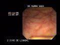 http://www.officialhealthtips.com

Video Hemorrhoids rubber band ligation 2

Other hemorrhoids surgery types:
hemorrhoidectomy, laser coagulation, infrared photocoagulation, injection sclerotherapy, rubber band ligation, doppler Guided Hemorrhoid Artery Ligation


http://www.officialhealthtips.com