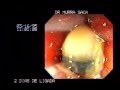 Video Hemorrhoids rubber band ligation 2