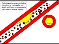 Atherosclerosis and Ischaemic Stroke