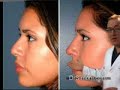 Non Surgical Nose Job (part 1): Introduction