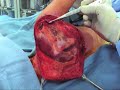 Total Scapula Prosthesis Ewings Sarcoma Part 1 Incisionand E