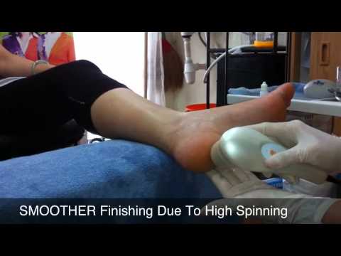 how to remove callus