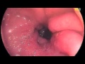 Stomach Ulcer Video