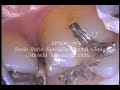 Prevention: Plaque control