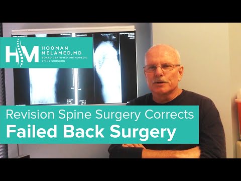 how to repair kyphosis