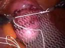 Robotic laparoscopic sacrocolpopexy for vaginal vault