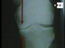 Presentan implantes de rodilla  