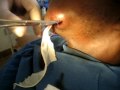 MCHS Dental Training Video 011 Incision and Drainage 0001
