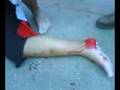 videos de fractura de carlitos parte 2