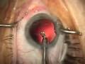 Modern Cataract Surgery, vol. 3 Modern Cataract Surgery, vol. 3