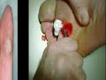 GCSE PE Edexcel A6 - Verruca & Athletes Foot