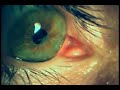eye