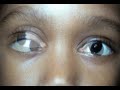 Patrick DeRespinis MD Pediatric Ophthalmology | Residency: New Jersey Medical School | Fellowship:Manahattan Eye, Ear & Throat Hospital Author of 