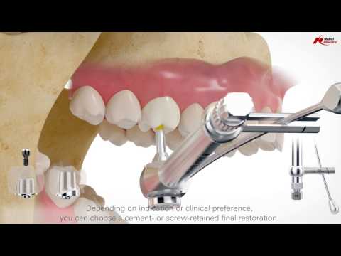 On1 concept: intraoral scanning | Nobel Biocare