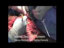 Dr. James Wittig: Radical Resection of Distal Femur [Part 1]