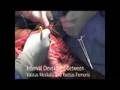 Dr. James Wittig: Radical Resection of Distal Femur [Part 1]