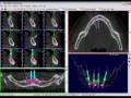 videos de Bioparts - Tutorial 10 DentalSlice: Salvando o projeto