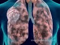 Smoking Causes COPD, Emphysema, Lung Cancer