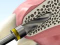 dental implant educational video from dentalmumbai.com dental implant educational video from dentalmumbai.com