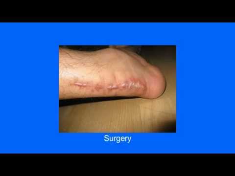 how to dissolve scar tissue under the skin