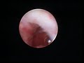 Post-Pancreatic Duct Dilitation Post-Pancreatic Duct Dilitation