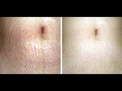 how to eliminate stretch marks