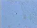 bacterial vaginosis clue cells bacterial vaginosis clue cells