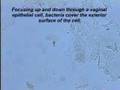 Bacterial Vaginosis