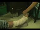Didjeridoo Healing fractured casted ankle of Peter Green