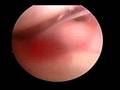 my-shoulder-surgery