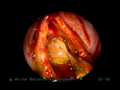 how to identify csf leak