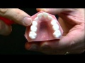 WHAT IS DIFFERENCE BETWEEN BANDED AND BONDED EXPANDER-YouTube-1-1-1-1.mov