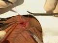 Operaci�n de vasectom�a