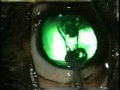 Artificial Lens Implantation on Dog - Tufts Veterinary (Video 3 A)