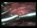 laparoscopy for repair of rupture of urinary bladder