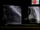 Angiograf�a tras by-pass