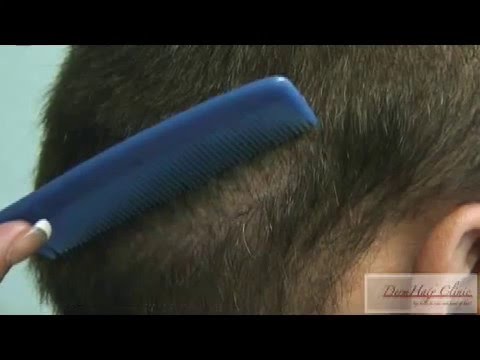 how to remove hair transplant scar