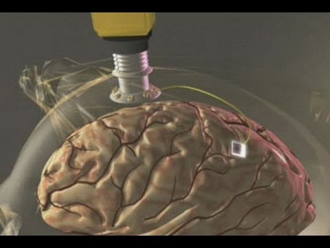 Government Unveils Brain Implant That “Restores Lost Memories” Government Unveils Brain Implant That “Restores Lost Memories”