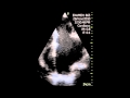 Spontaneous Echo Contrast Spontaneous Echo Contrast