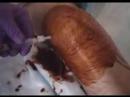 Arthrocentesis