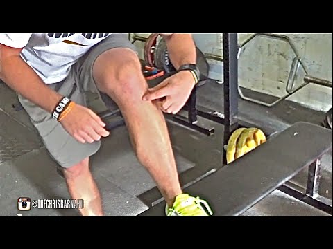 how to cure shin splints